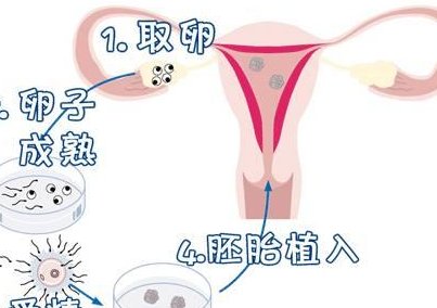 5分钟带你了解澳大利亚高龄三代试管全流程